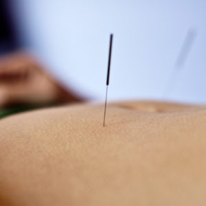 acupuncture médecine douce